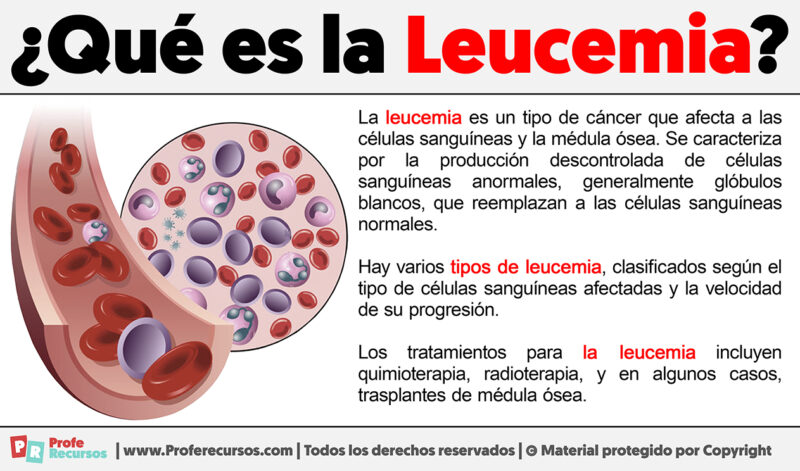 Qué Es La Leucemia Definición De Leucemia 4357