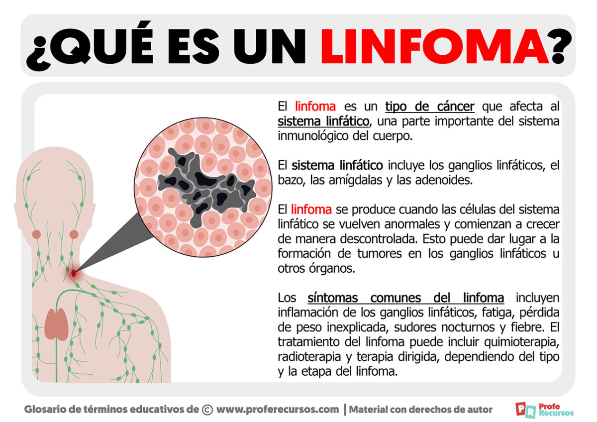 Qué es un Linfoma Definición de Linfoma